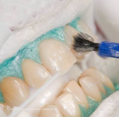 Power-Bleaching: Weiße Zähne in einem Termin